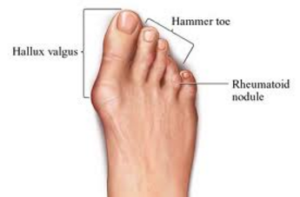 Forefoot Arthritis Shoe Recommendations (Hammertoes, Hallux Limitus ...